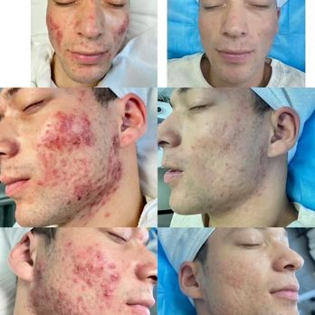 Acne care