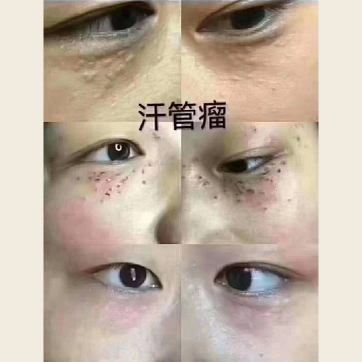 Eye-area care