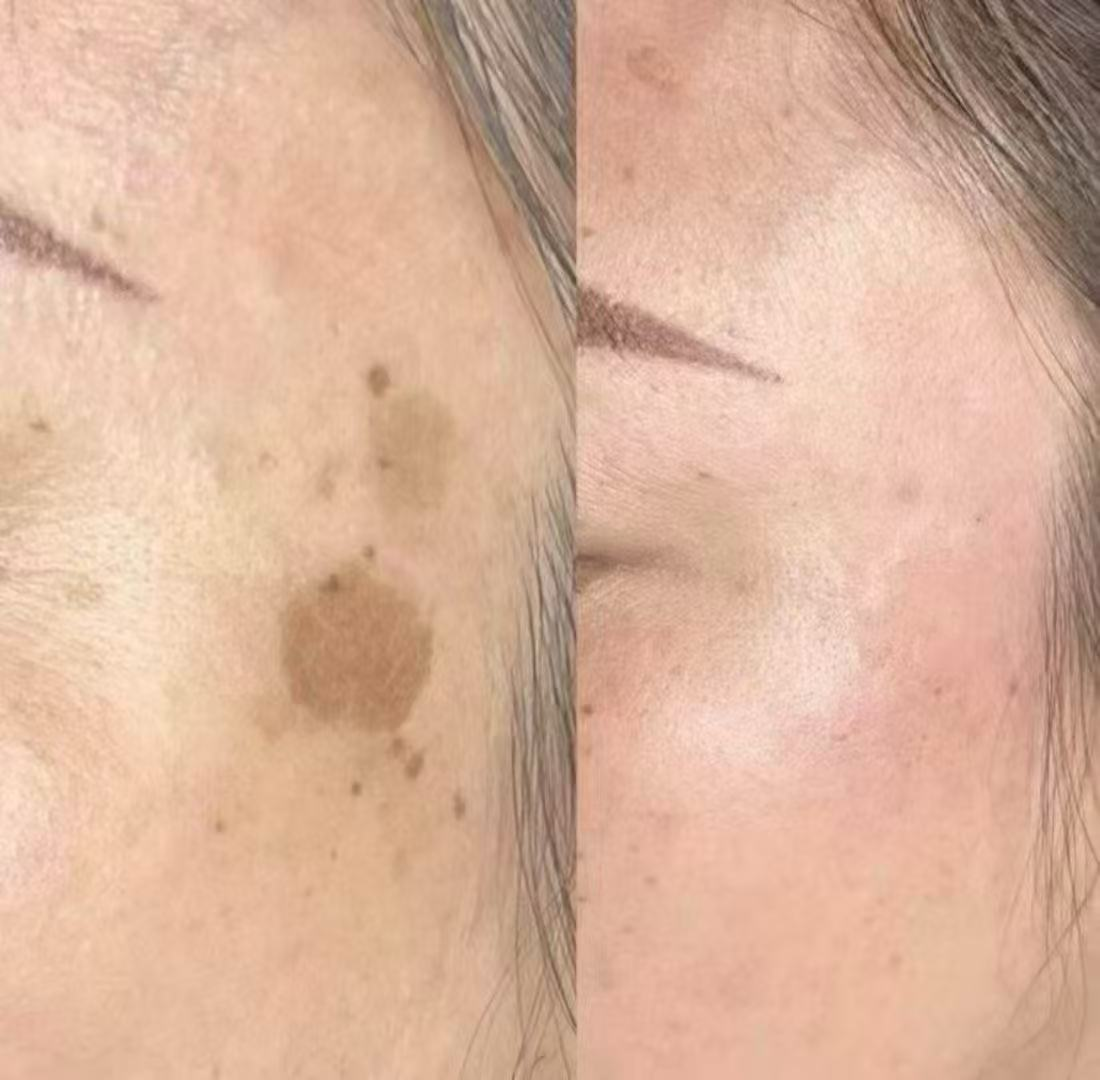 Dark spot removal