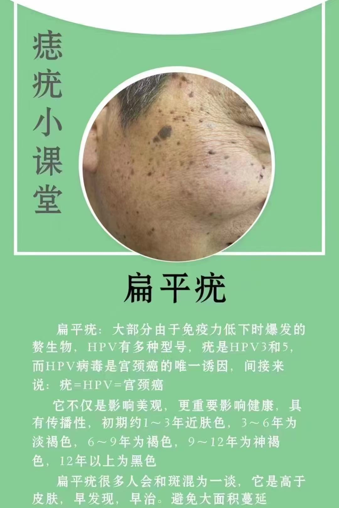 About flat warts · 扁平疣